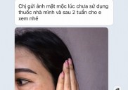 Trị Nám Ở Tiền Giang Của Chị Đặng Bé Hà.